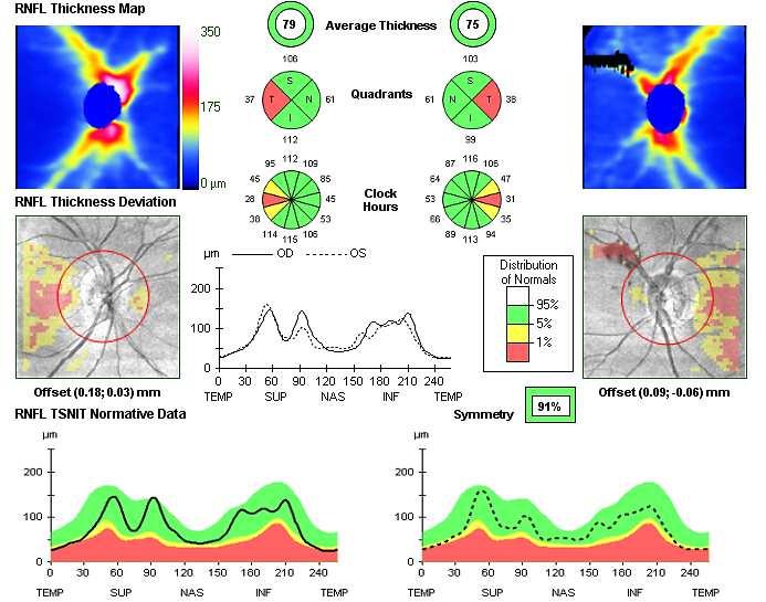 Mechanizmus chronické neurodegenerace axonů sítnice Temporální nervová vlákna sítnice mají menší diametr a jsou vulnerabilnější (méně mitochondrií,