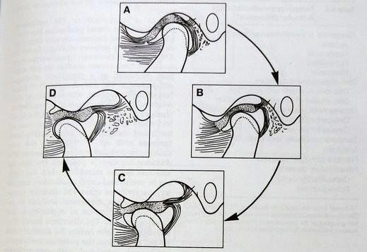 Biomechanika TMJ TMJ má dvě části, které se pohybují odlišným způsobem Discus articularis je klíčovým faktorem.