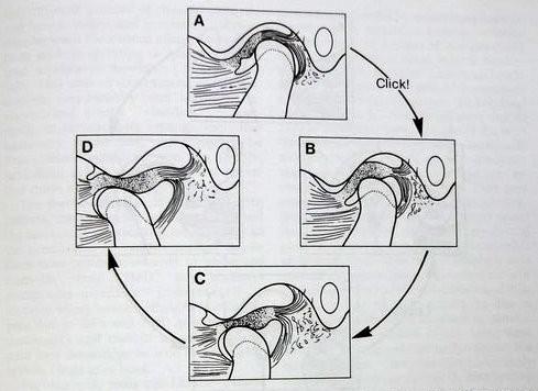 Lupání se objevuje při anteromedialním posunu disku, což musí kondyly překonat, aby dosáhli své normální pozice pro plné otevření úst.