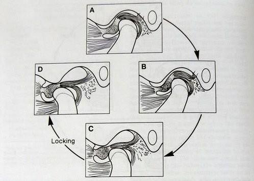 Mechanismus blokování mandiulární deprese následkem anteriorní dislokace kloubního disku A- klidová pozice B jak se kondyl posunuje dopředu, naraží