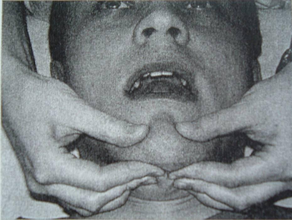 Stabilizační cvičení- rytmická stabilizace Vychází z PNF- pacient se snaží o udržení výchozí pozice proti tlaku ruky terapeuta Pac. Má mírně pootevřená ústa s jazykem na horním patře, ter.