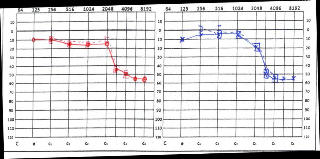 práh sluchu pro vzdušné vedení, můžeme hodnotu zkontrolovat přidáním 10 db maskovacího šumu a zopakováním měření na dané frekvenci. 3.1.3 Interpretace výsledků Obvykle se výsledky prezentují graficky.