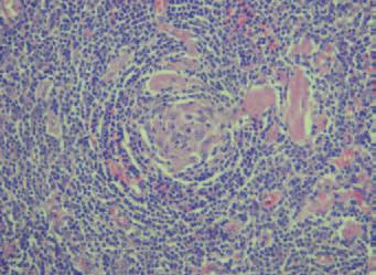 Peroperační krevní ztráta byla 1 800 ml. Tumor byl makroskopicky velmi tuhý, nedobře ohraničený, velmi silně vaskularizovaný a při naříznutí obsahoval kalcifikace. Obr. č.