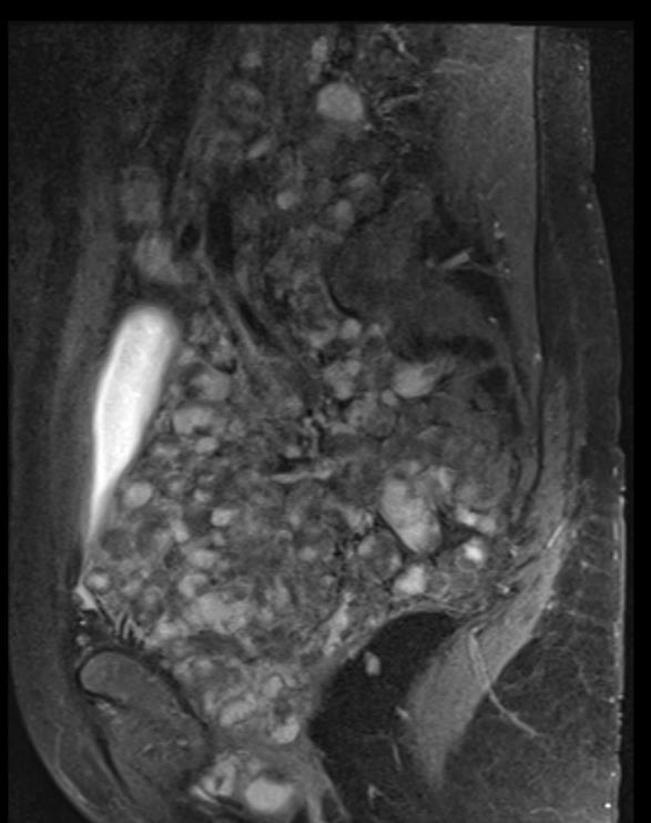 NEUROGENNÍ TUMORY CT