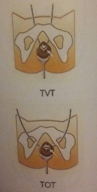 TVT, TOT operace Burchova vaginální