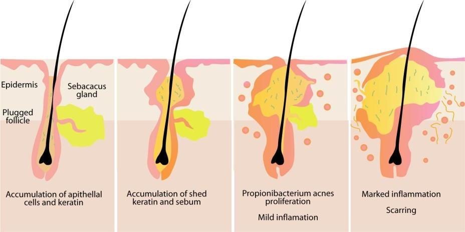 Propionibacterium acne