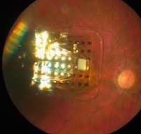 2. Současný stav ve výzkumu bionického oka 19 Implantát obsahuje 60 elektrod, které jsou vloženy do oka a přichytány k makule.