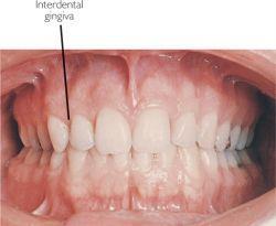 Dáseň (Gingiva) linea mucogingivalis gingiva alveolaris (pars affixa gingivae) = přisedlá dáseň růžová, tečkovaná, rohovějící free gingival groove gingiva marginalis