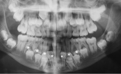 nahradit chybějící zub z trvalé generace novým, v případech některých vzácných vývojových poruch, například u kleidokranialní dysplazie, může dojít ke vzniku další zubní generace (obrázek 21), což