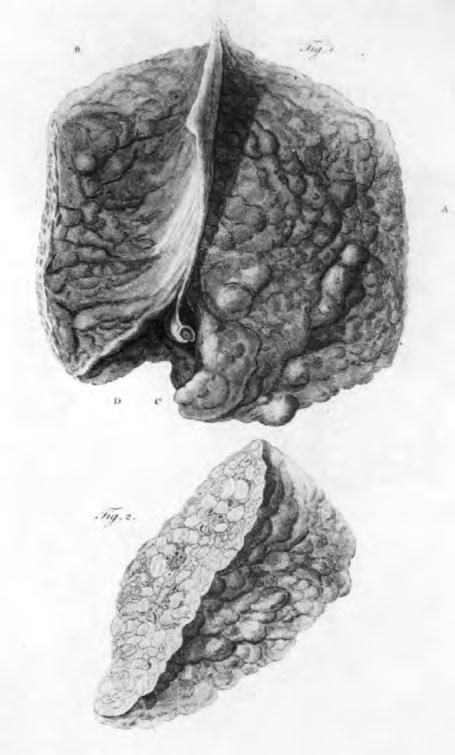 6 Hepatologie Obr. 1.3 Titulní stránka překladu řeckého spisu do latiny v roce 1735 (překladatel: Hermann Boerhaave) Obr. 1.5 Ilustrace cirhotických jater (Baillieho atlas z roku 1800) Obr. 1.4 Matthew Baillie (1761 1823) (T.