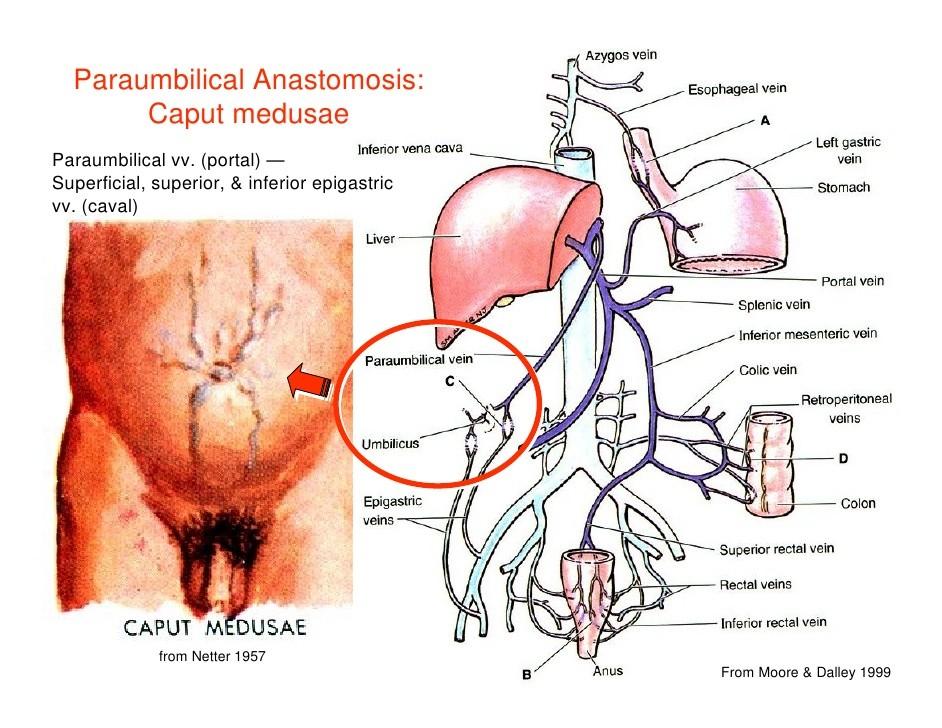 mohou při prasknutí způsobit životu nebezpečné krvácení do dutiny břišní. Anastomóza je tvořena následujícími žilami: vena portae levá žaludeční žíla (vena gastrica sinistra) x jícnové žíly (vv.