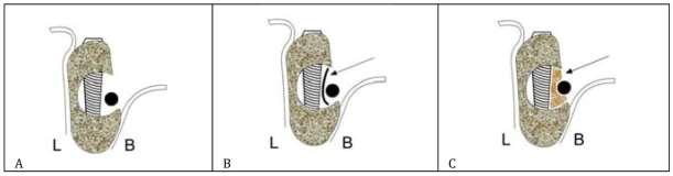 A B Canalis retromolari s A,B,C) IKC