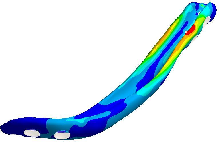 8.3 ANALÝZA NAPĚTÍ FIXAČNÍ DLAHY PAC 2 U fixační dlahy byla analyzována hlavní napětí 1 a 3 a ekvivalentní napětí HMH.