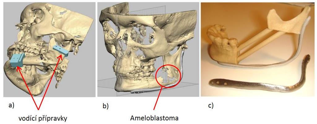 metod zpracování obrazu a metod 3D tisku má nezastupitelné místo v medicíně, a zvláště chirurgických oborech, v diagnostice onemocnění a při plánování léčby.