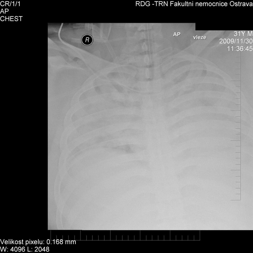 1. kazuistika: Pneumonie chřipka A (H1N1)2009