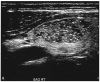 2.4.1 Sonografické vyšetření uzlů ve štítné žláze Sonografické vyšetření je metodou první volby, na jeho podkladě ale není možné s dostatečnou sensitivitou a
