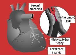 ALE POZOR NA RIZIKA ZVÝŠENÉ PA Kardiální rizika Vliv věku na riziko náhlé kardiovaskulární smrti