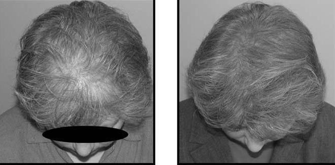 Androgenní alopecie prořídnutí na temeni a ve střední frontální