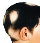 Alopecia areata syn.