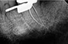 Pro nahřívaní GuttaCore vždy použijte nejnižší program. Mandibulární levý, druhý molar s délkou kořene 24,5 mm.