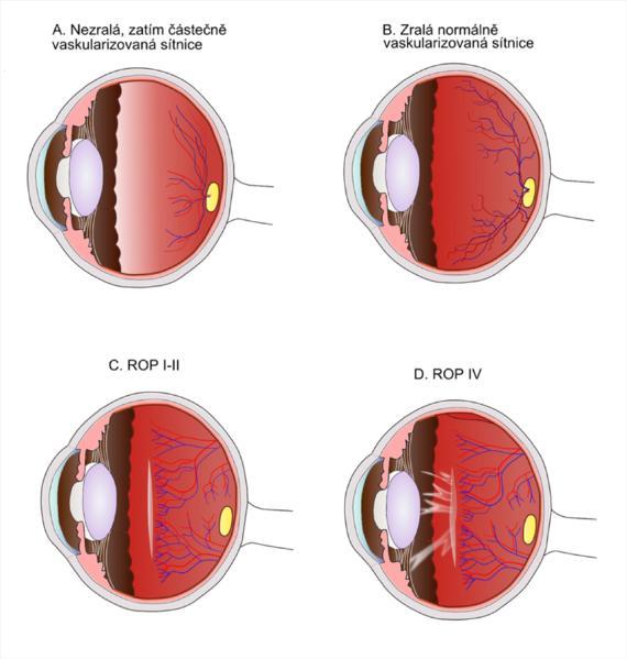 Obrázek 6 Retinopatie nedonošených Kortikální slepota Problémy se zpracováváním zrakových podnětů vznikajících u dětí s poškozením zrakového centra v kůře mozku.