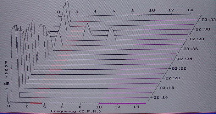 Obr. č. 10: Graf RSA- 16 minutový záznam s dominantním nálezem bradygastrie (PDF), reálné zobrazení v programu Gastrosoft.