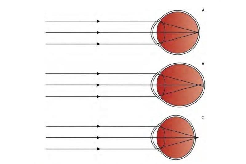 4ZRAK Obrázek 4: Emetropické oko (A), myopické oko (B) a hypermetropické oko (C) Zdroj: Šikl 2012 4.3.