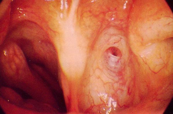 Rinitida neventilovaného nosu Rinitida u nemocných po laryngektomii/tracheostomii nos je vyloučen z ventilace, nedochází k cyklickým změnám teploty a vlhkosti.