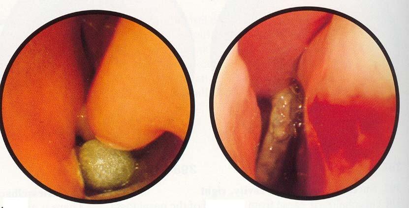 Strukturální deformity nosu: Intranazální cizí tělesa Převzato z Becker