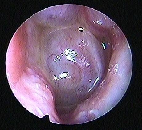 Pansinus operace Indikace : chronické záněty s polypózou - viz mezinárodní konsenzus Co.i.. S.