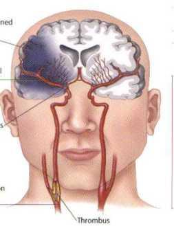 Mozkové krvácení po intravenosní trombolýze Dagmar Sváčková Iktové centrum,