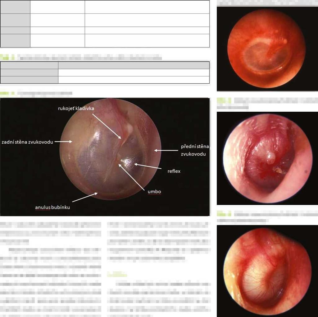 PŘEHLEDOVÉ ČLÁNKY Záněty středního ucha u dětí omyly Při diagnostice a léčbě Tab. 2. Čtyři stadia akutního zánětu středního ucha 1.