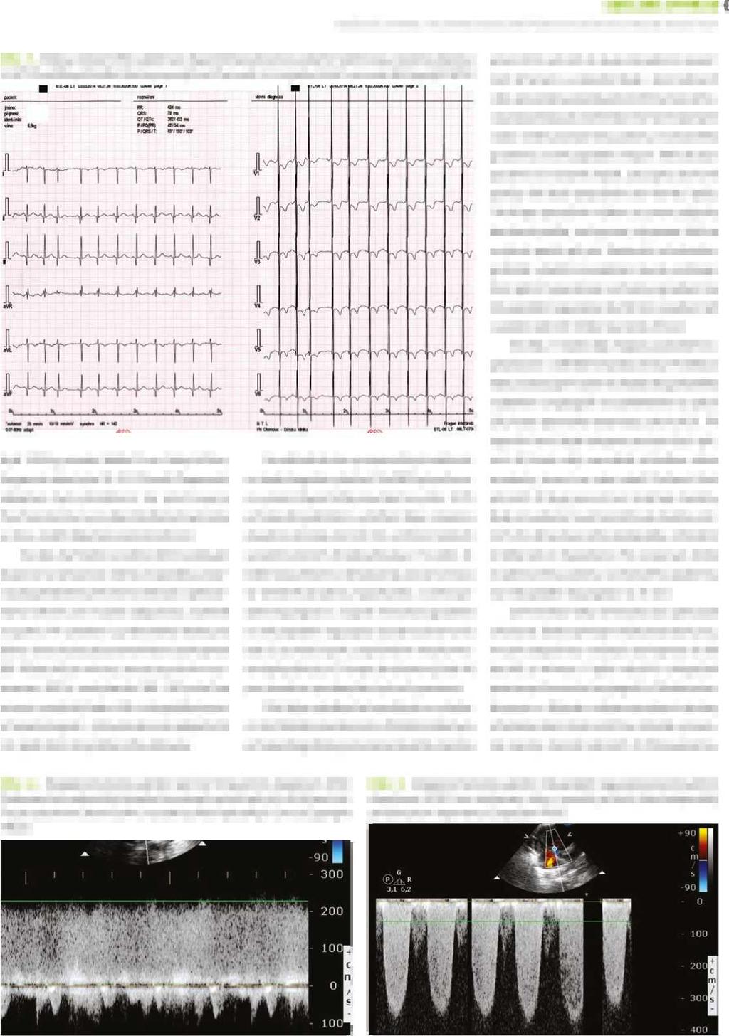 SDĚLENÍ Z PRAXE narůstající dyspnoe a tachypnoe jako Hlavní PříZnak vzácné kritické vrozené srdeční vady Obr. 1. Klidový záznam EKG svědčící pro hypertrofii pravé komory srdeční.