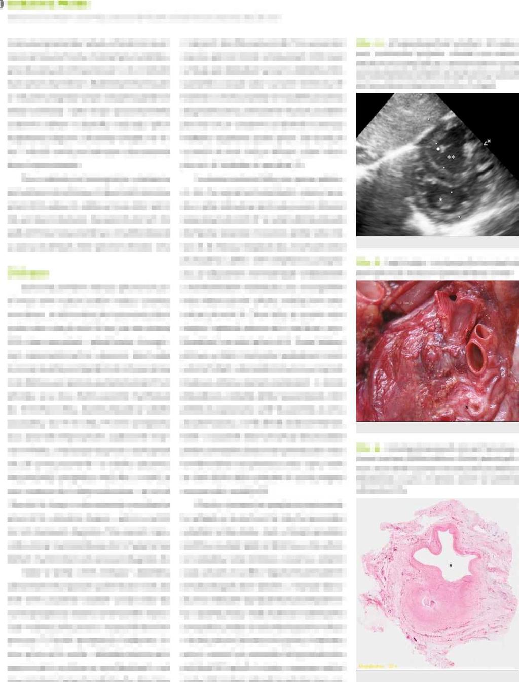 SDĚLENÍ Z PRAXE narůstající dyspnoe a tachypnoe jako Hlavní PříZnak vzácné kritické vrozené srdeční vady lonková angioplastika nebyla vzhledem k závažnosti stenózy technicky možná.