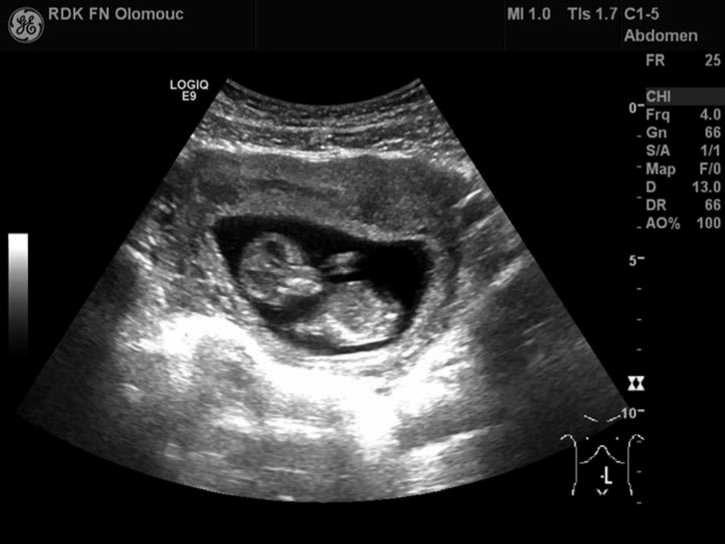KLINICKORADIOLOGICKÁ DIAGNÓZA dospívající dívka se Zvracením, nevolností, bolestí břicha a úbytkem Hmotnosti jako Projevy těhotenství Obr. 1. UZ vyšetření pánve.