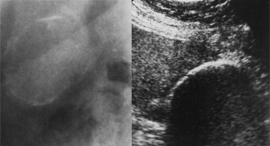 Abnormality - žlučníku Hydrops rozšíření nad 4cm šíře (12cm délky) klinika!