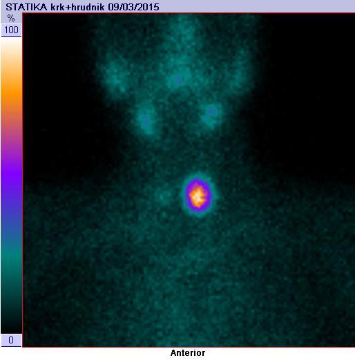 Obrázek 6: Scintigram autonomního adenomu tyreoidey po
