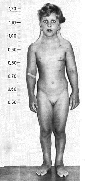 neuploidie u člověka urnerův syndrom, 2n=45, XO malá postava, nevyvinuté vaječníky; krk s řasami, cubitus valgus (vbočený loket), štítovitý hrudník, lymfedém
