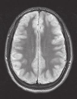 POTRAUMATICKÝ SYNDROM NEPŘIMĚŘENÉ SEKRECE ANTIDIURETICKÉHO HORMONU Obr. č.