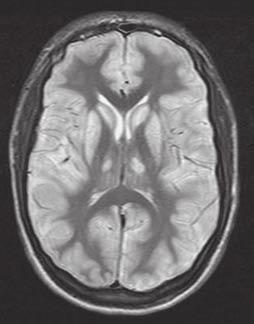 5: Patofyziologický podklad syndromu nepřiměřené sekrece antidiuretického hormonu (SIADH) nadprodukce ADH hypervolémie natriuretické peptidy ( sodium escape ) euvolémie, diluční hyponatrémie příjem