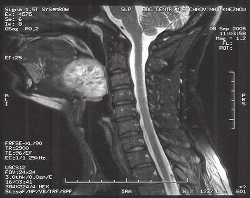 Následné endokrinologické vyšetření včetně aspirační biopsie a magnetické rezonance (MR) potvrdilo diagnózu hypofunkční linguální ŠŽ bez přítomnosti v její typické pretracheální lokalitě.