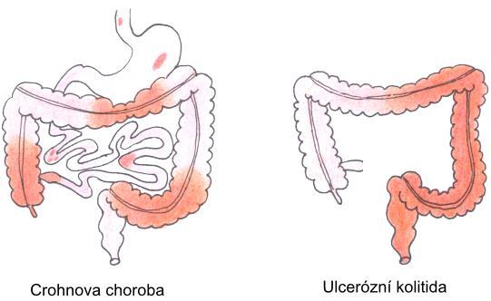 Nicméně, v případě IBD se zdá, že jedinci s genetickou predispozicí ztrácí normální toleranci k symbiotickým bakteriím, což vede ke zvýšené zánětlivé reakci (Geier et al., 2007).