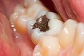 Ortuť zdroje expozície Ako zdroje ortuti sú známe amalgámové výplne zubov ich počet,