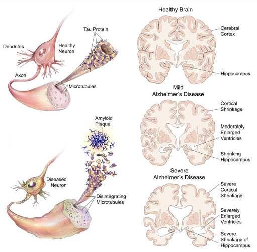 Alzheimerova demence (AD) neurodegenerace neznámé etiologie 60-70% případů demence ztráta synapsí v kortexu (ACh, 5-HT), atrofie akumulace betaamyloidu, tau proteinu, tvorba amyloidních plaků Příčiny