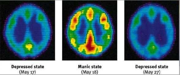 Mánie Mánie: Zvýšená funkce DA, noradrenalinu a serotoninu Snížená funkce GABA Antimanika Stabilizují náladu, odstraňují epizody mánie i deprese lithium Antiepileptika karbamazepin valproát