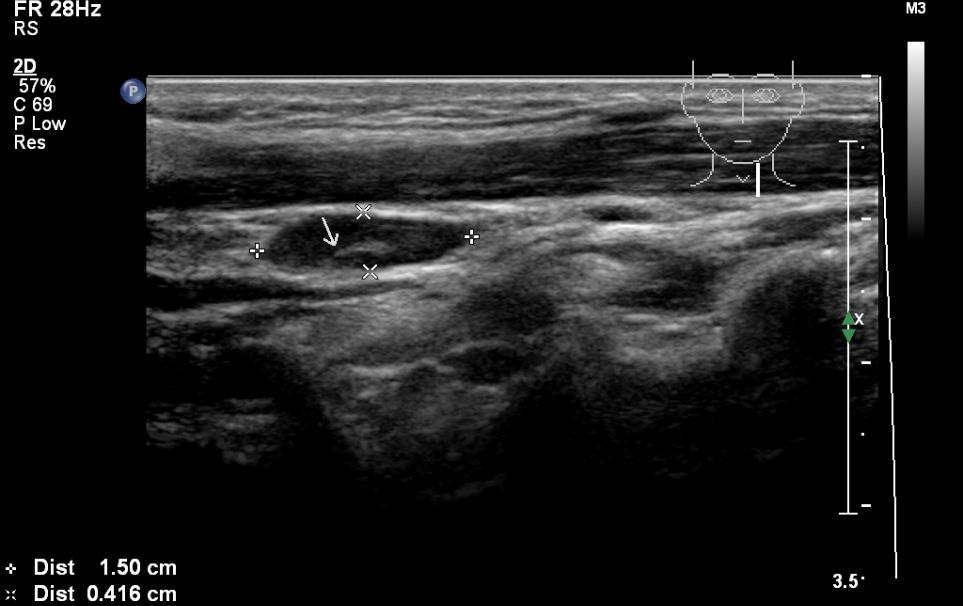 Ultrasonografie uzlin (4) Podélný