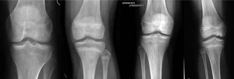 357/ Acta Chir Orthop Traumatol Cech. 84, 2017, No. 5 PŮVODNÍ PRÁCE Obr. 1. Rtg stadia OCHD seřazeno zleva od I. do IV. stupně: I. stupeň negativní nález; II.