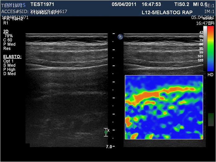 KAPITOLA 4. ELASTOGRAFIE 117 4.3 Ultrazvuková elastografie K zobrazení elastických vlastností tkání se používají ultrazvukové vlny, podobně jako u diagnostického ultrazvuku.