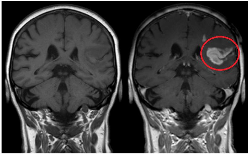 KAPITOLA 3. MAGNETICKÁ REZONANCE 83 Obrázek 3.15: T1 obraz mozku s hematomem po mozkové mrtvice, zvýrazněný po aplikaci MRI kontrastní látky. Převzato z: http://en.wikipedia.