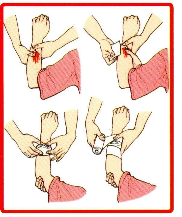 Cudzie teleso v rane 1. chránime sa gumenými rukavicami a sprístupníme celú ranu (odstránime odev), 2. cudzie teleso neodstraňujeme! 3.